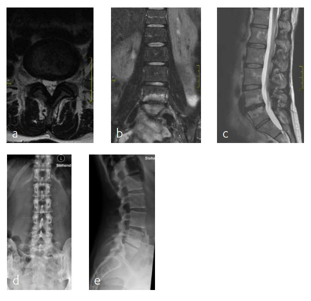 Stand-alone anterior interbody fusion with the Synfix Evolution