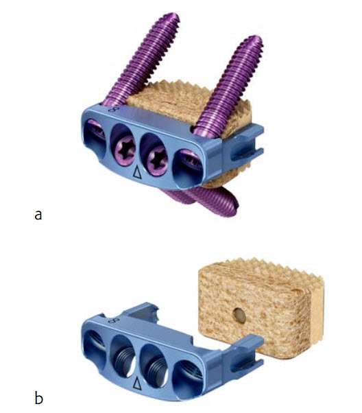Zero-P Natural Anterior Cervical Plate