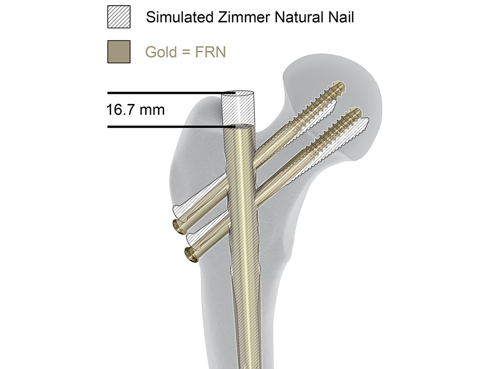 Interlocking Nails intramedullary tibia femur instrument set