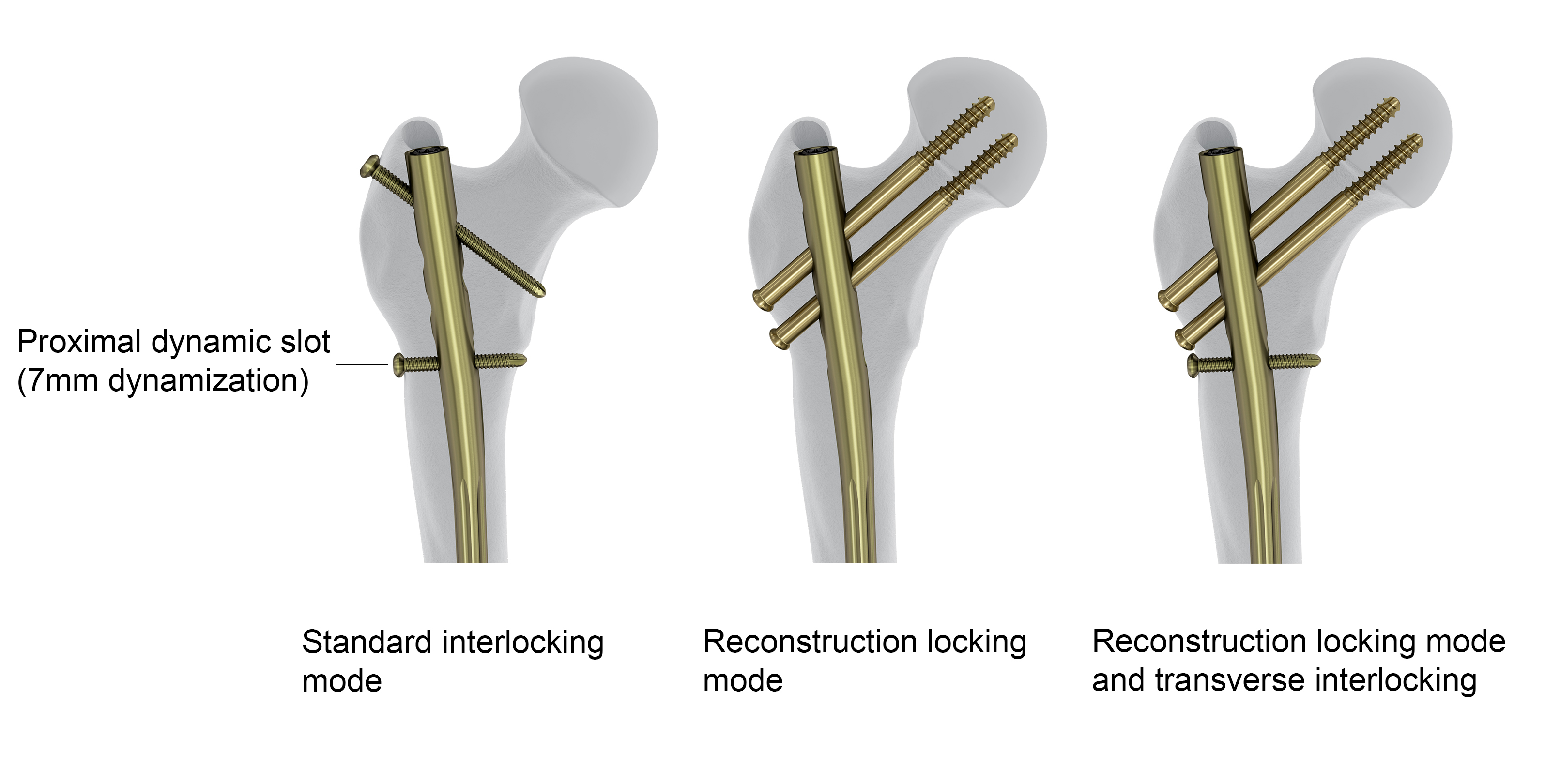 FRNADVANCED Femoral Recon Nailing System  Products  DePuy Synthes