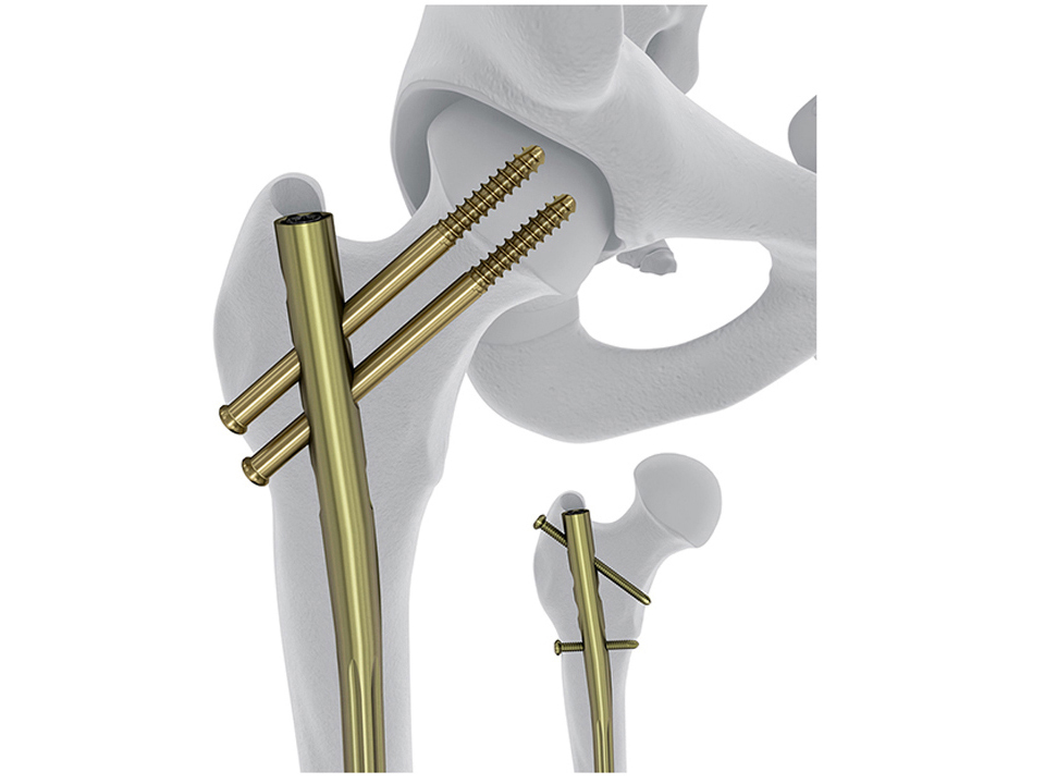 Femoral Recon Nail System FRN System  DePuy Synthes