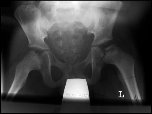 90_toddler_osteotomy_plate_2