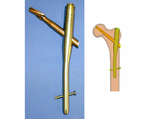 Medicina | Free Full-Text | Intertrochanteric Femoral Fractures: A  Comparison of Clinical and Radiographic Results with the Proximal Femoral  Intramedullary Nail (PROFIN), the Anti-Rotation Proximal Femoral Nail (A-PFN),  and the InterTAN Nail