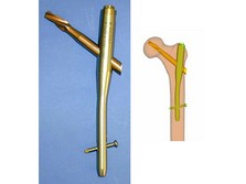 Trochanteric Fixation Nail (TFN)