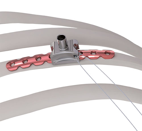 Fig 5d Guide with suture