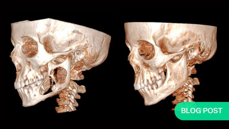 How a simple drug transformed the future of three young ameloblastoma patients