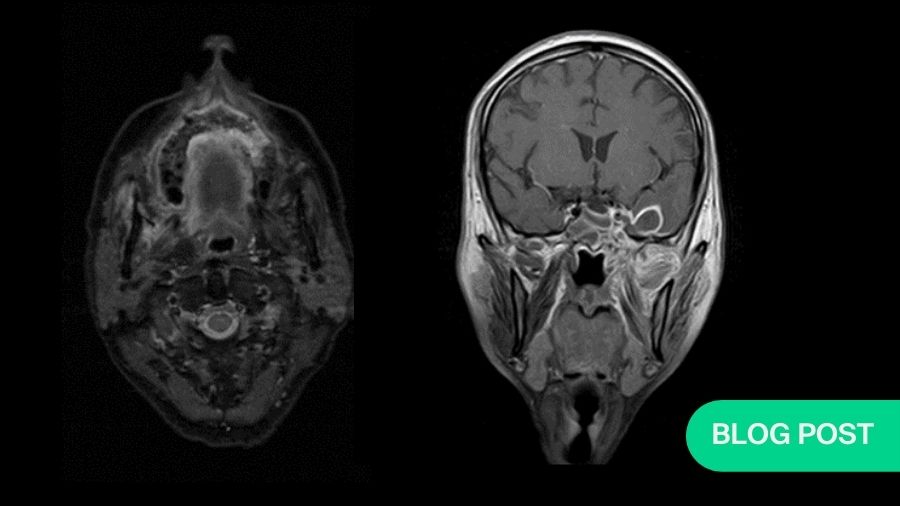 Lessons from Covid Associated Mucormycosis: A Memoir of a Maxillofacial Surgeon | AO CMF