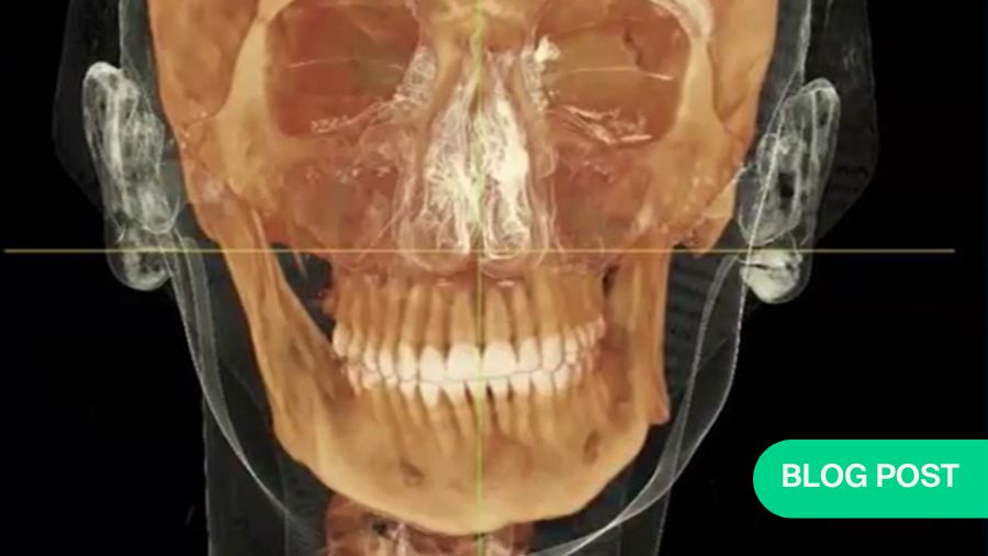 How to maximize accuracy and streamline orthognathic surgery with virtual surgical planning
