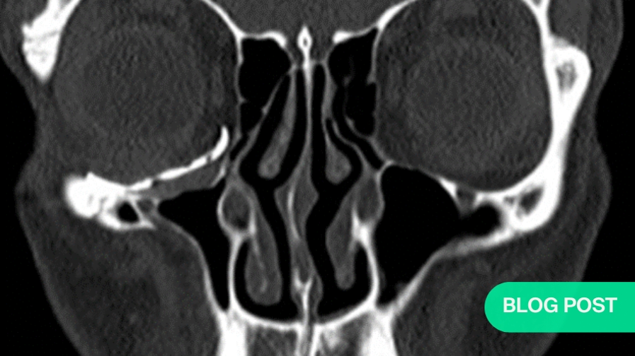 Silent Sinus Syndrome