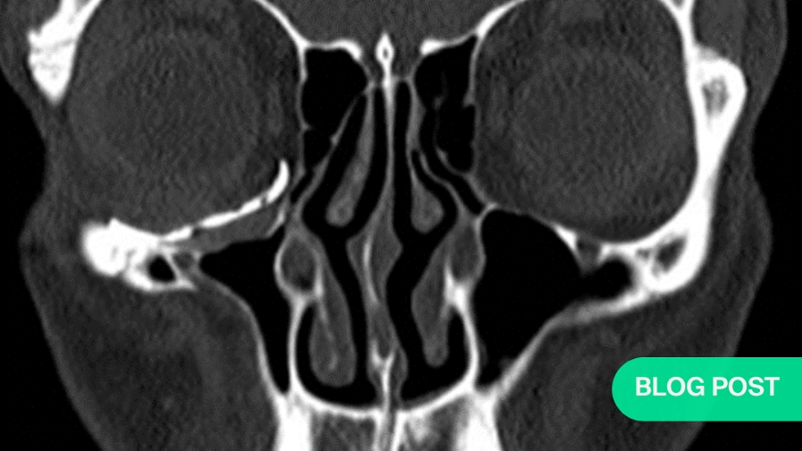 Orbital Reconstruction: How patient specific technologies helped with desired outcome in Silent Sinus Syndrome