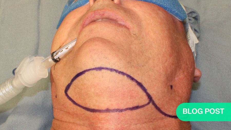 The submental artery island pedicled flap in reconstructive surgery in the head and neck