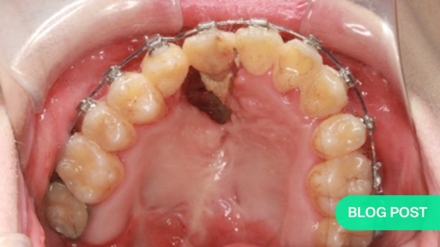 Salvage procedures in cleft palate: managing alveolar oronasal fistulae