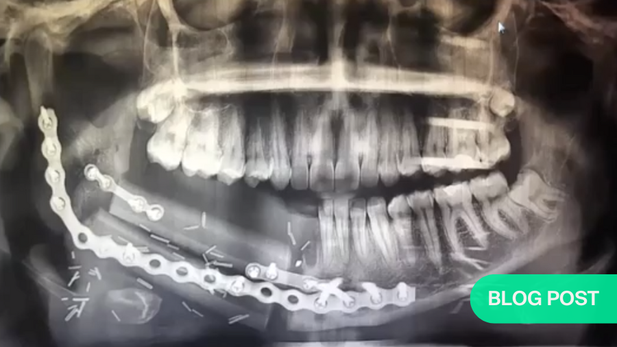 Oral cancer—flap use can restore functional, aesthetic, and quality-of-life after major oral resection