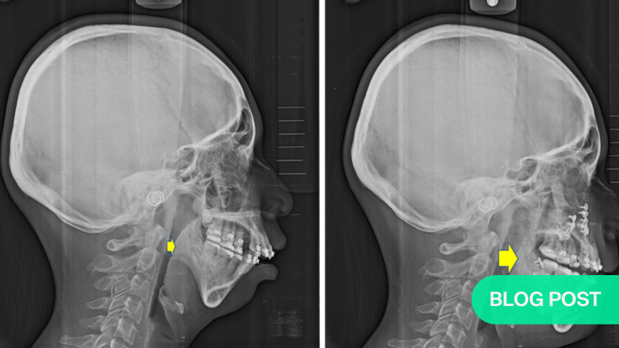 Orthognathic surgery enhances obstructive sleep apnea management—lifestyle changes precede surgical intervention