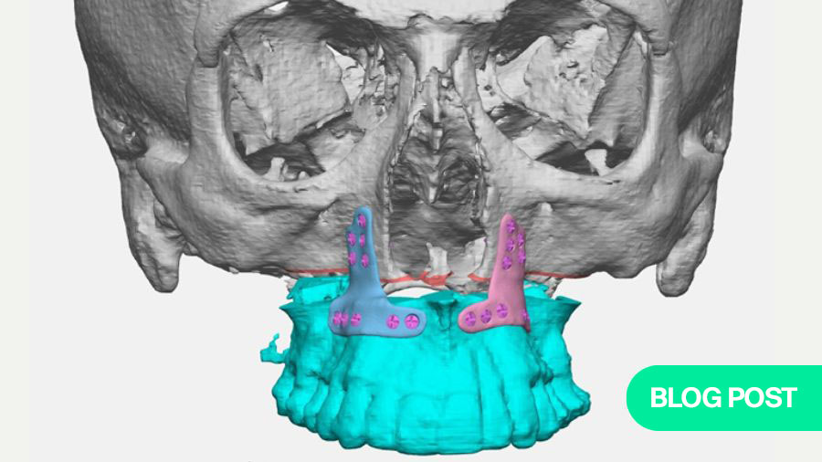 Maxilla- or mandible-first approach: what is the rationale?
