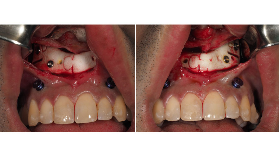 Intraoperative photographs showing cutting guide placement