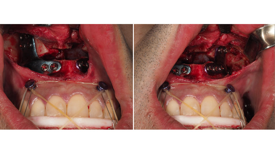 Intraoperative photograph showing the “inverted T” custom plates