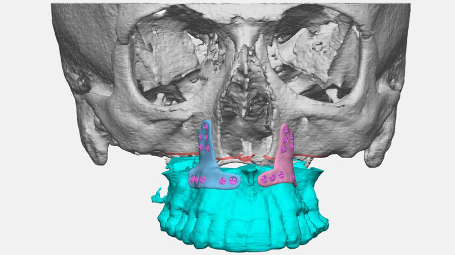 Virtual orthognathic surgical plan showing the inverted T plates