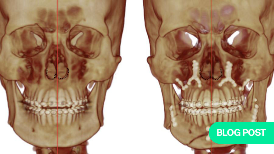 AO CMF Incubator study reveals improved nasal positioning with minimally invasive orthognathic surgery technique