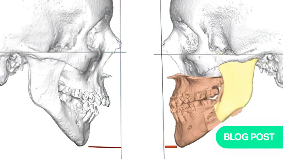 Sequencing in orthognathic treatment: the maxilla-first approach for predictable outcomes