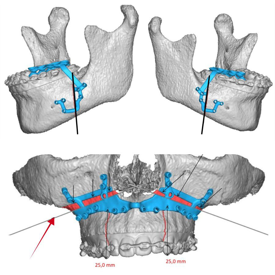 Orthognathic Surgery: from wired jaws to 3D planning