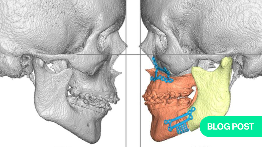 Orthognathic Surgery: from wired jaws to 3D planning