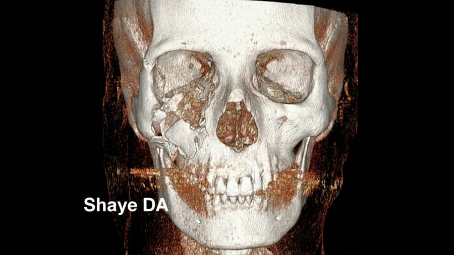 VSP, 3D modeling and AR welcome the new era of personalized CMF surgery