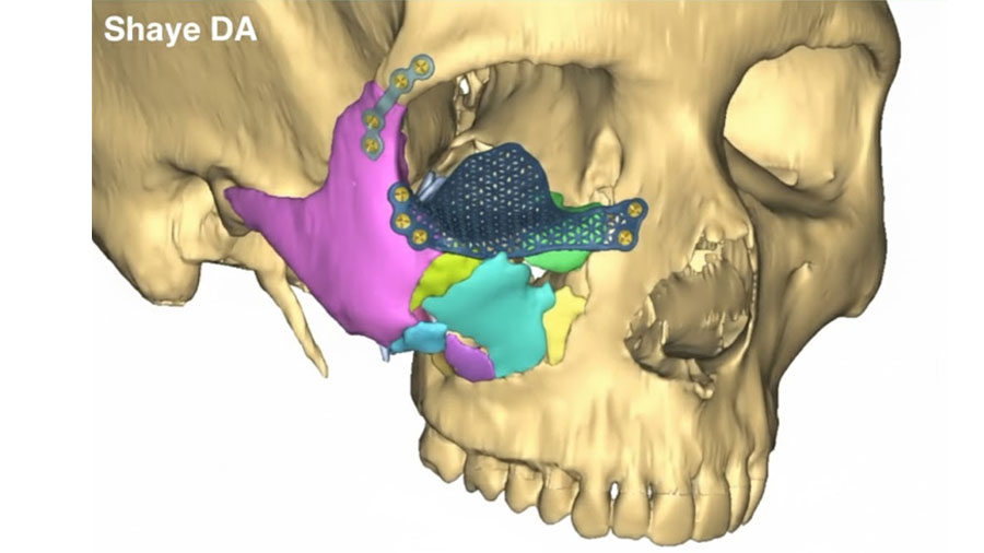 VSP, 3D modeling and AR welcome the new era of personalized CMF surgery