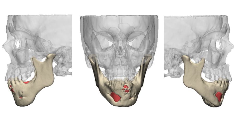 Precision Surgery—balancing risk and impact in maxillofacial surgery
