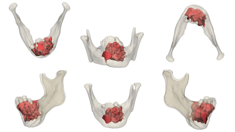 Precision Surgery—balancing risk and impact in maxillofacial surgery