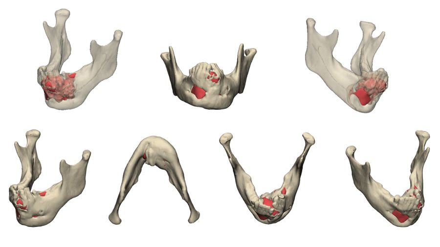 Precision Surgery—balancing risk and impact in maxillofacial surgery