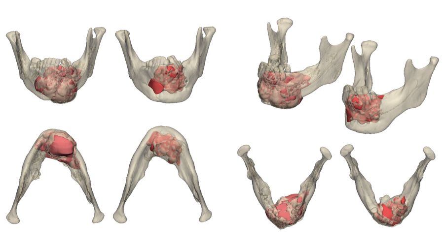Precision Surgery—balancing risk and impact in maxillofacial surgery
