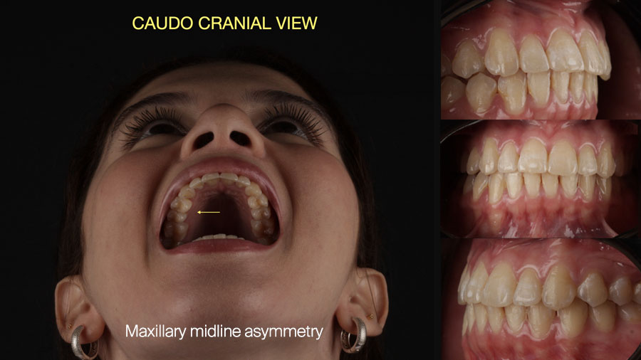 Fig 1: Caudo Cranial View