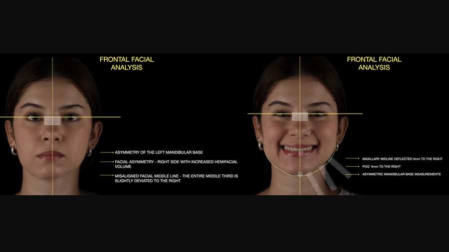 Fig 2: Frontal Facial Analysis