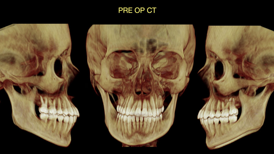 Fig 3: Pre Op CT