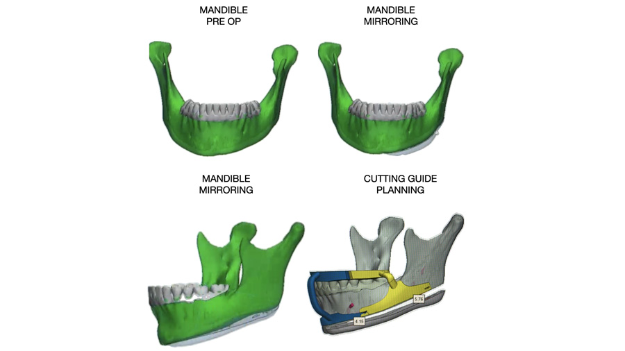 Fig 4: Mandible Pre Op and Mirroring, Cutting Guide Planning