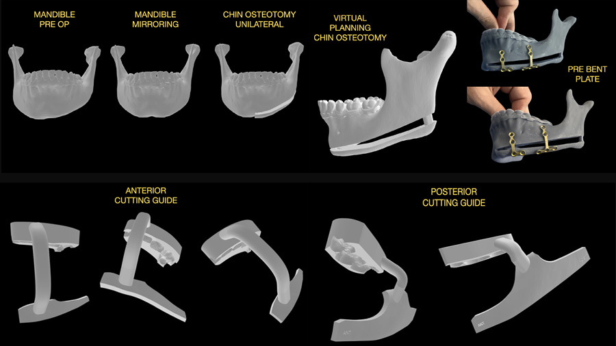 Fig 5: Planning, models, and cutting guides