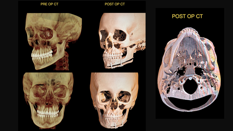 Fig 6: Pre Op and Post Op CT