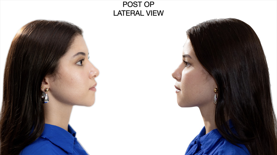 Fig 7: Post Op Lateral View