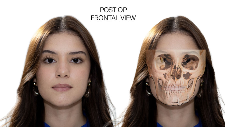 Fig 8: Post op frontal view