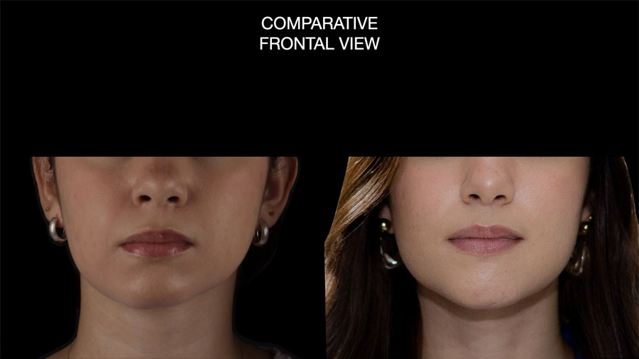 Fig 9: Comparative Frontal View