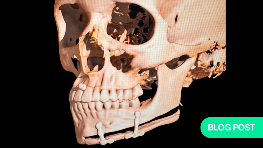 Restoring facial balance using a creative, cost-effective approach—how a customized unilateral wing osteotomy corrected mandibular asymmetry
