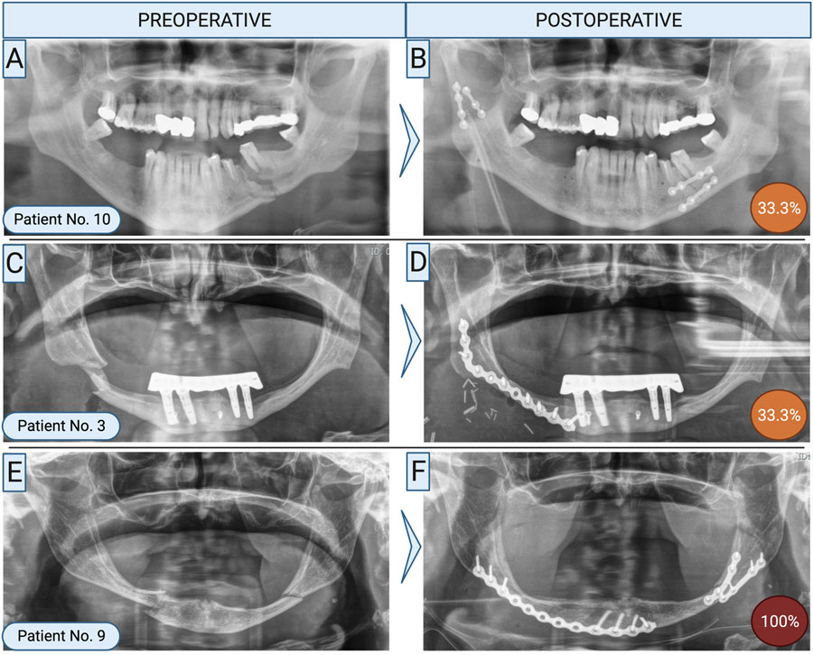 Revision surgery with refixation after mandibular fractures