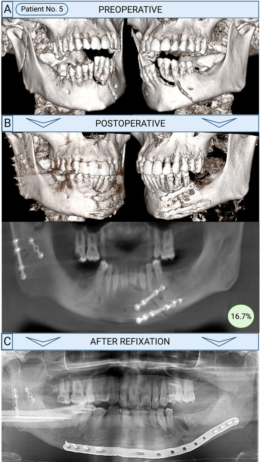 Revision surgery with refixation after mandibular fractures