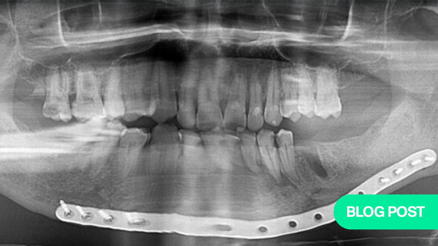 Revision surgery with refixation after mandibular fractures—what precautions should be taken?