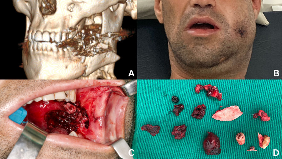 Mandibular fracture complications: a time-based guide for CMF surgeons