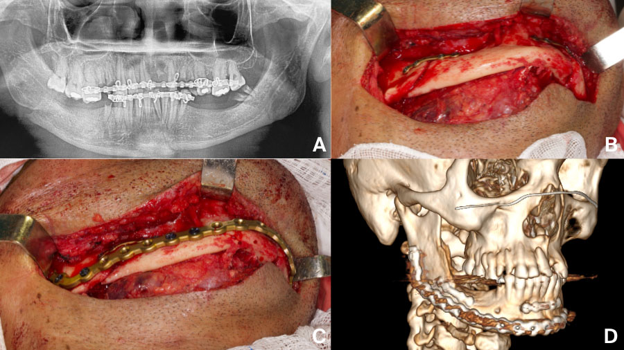 Mandibular fracture complications: a time-based guide for CMF surgeons
