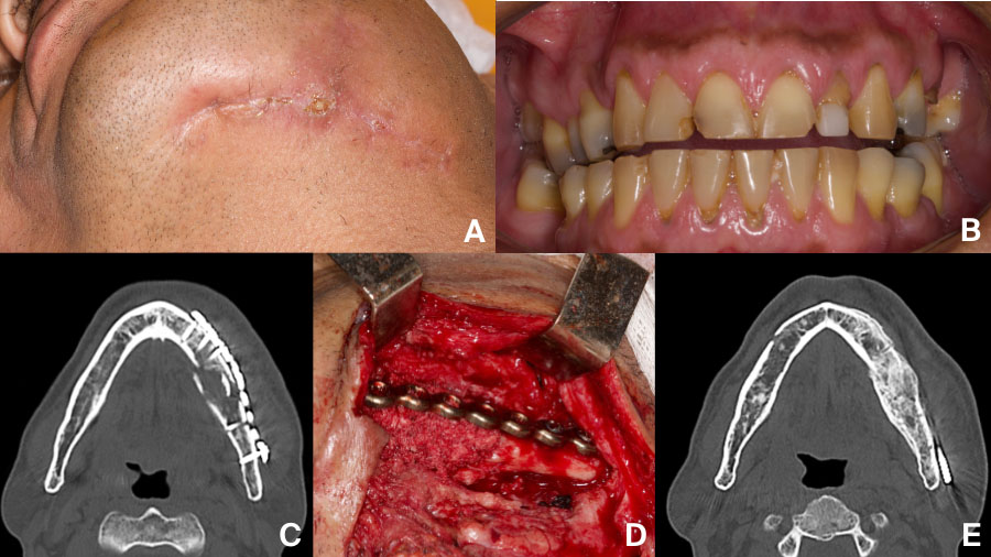 Mandibular fracture complications: a time-based guide for CMF surgeons
