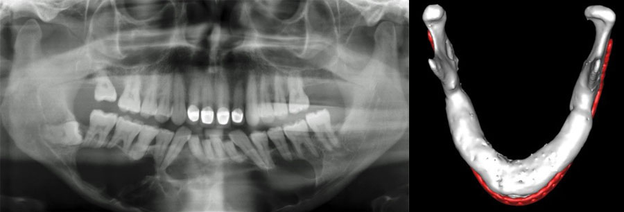 The particulate iliac crest bone graft: An overlooked alternative for mandibular reconstruction