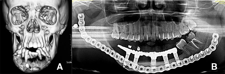 The particulate iliac crest bone graft: An overlooked alternative for mandibular reconstruction
